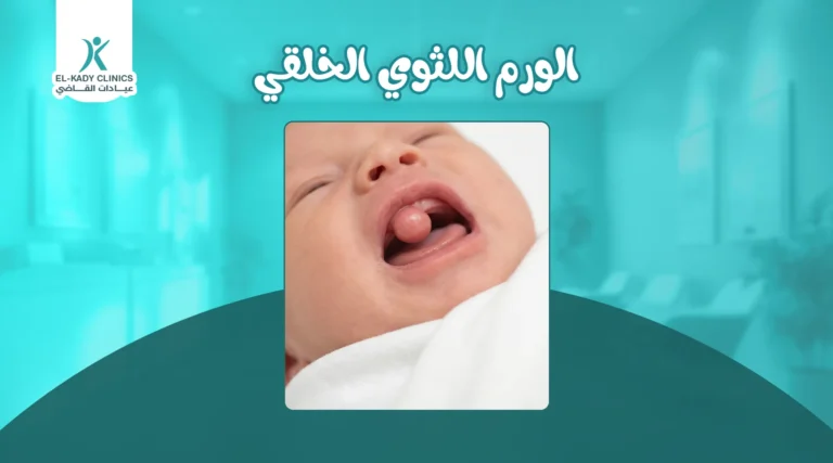 ورم نيومان: الورم اللثوي الخلقي لدى حديثي الولادة