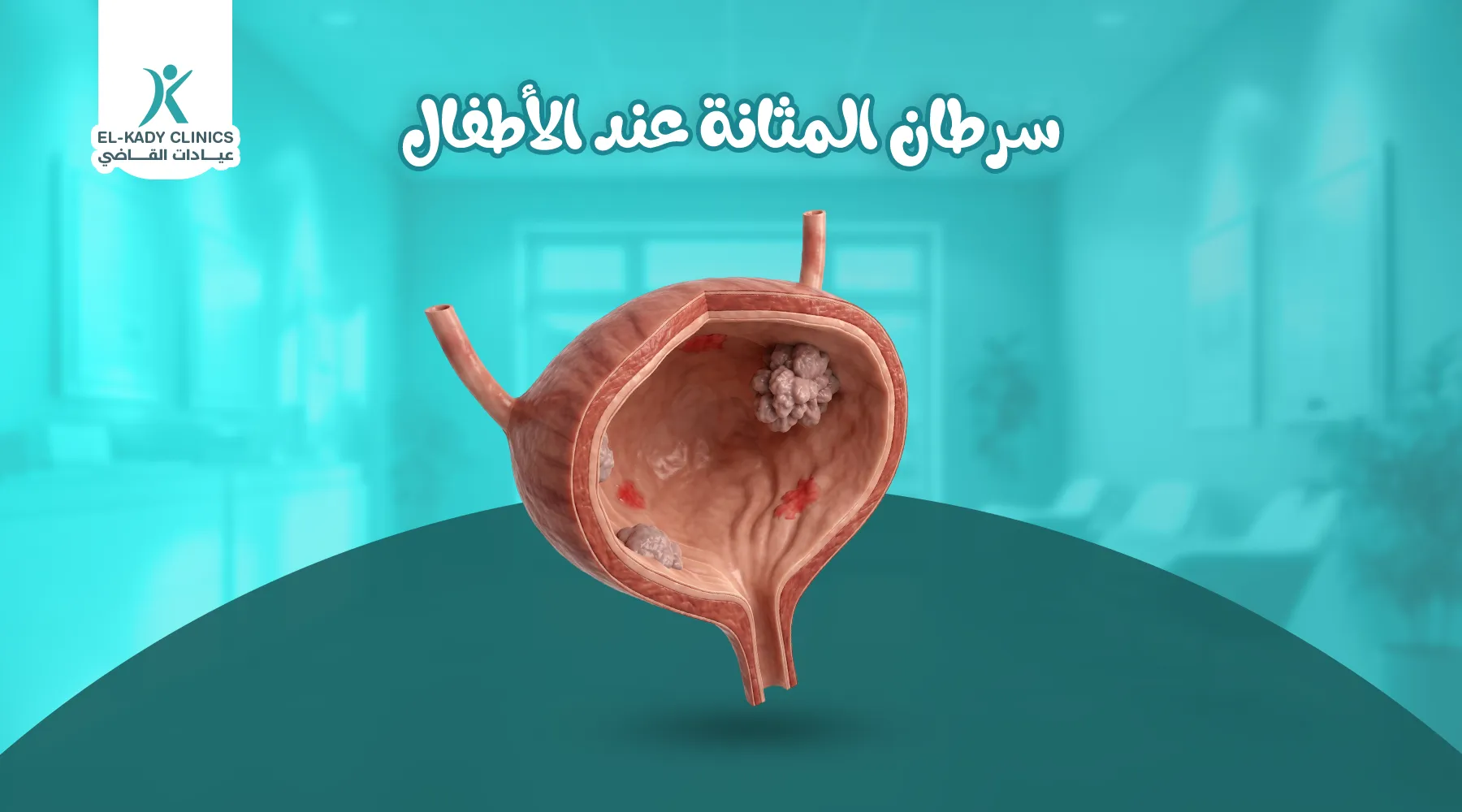 سرطان المثانة عند الأطفال