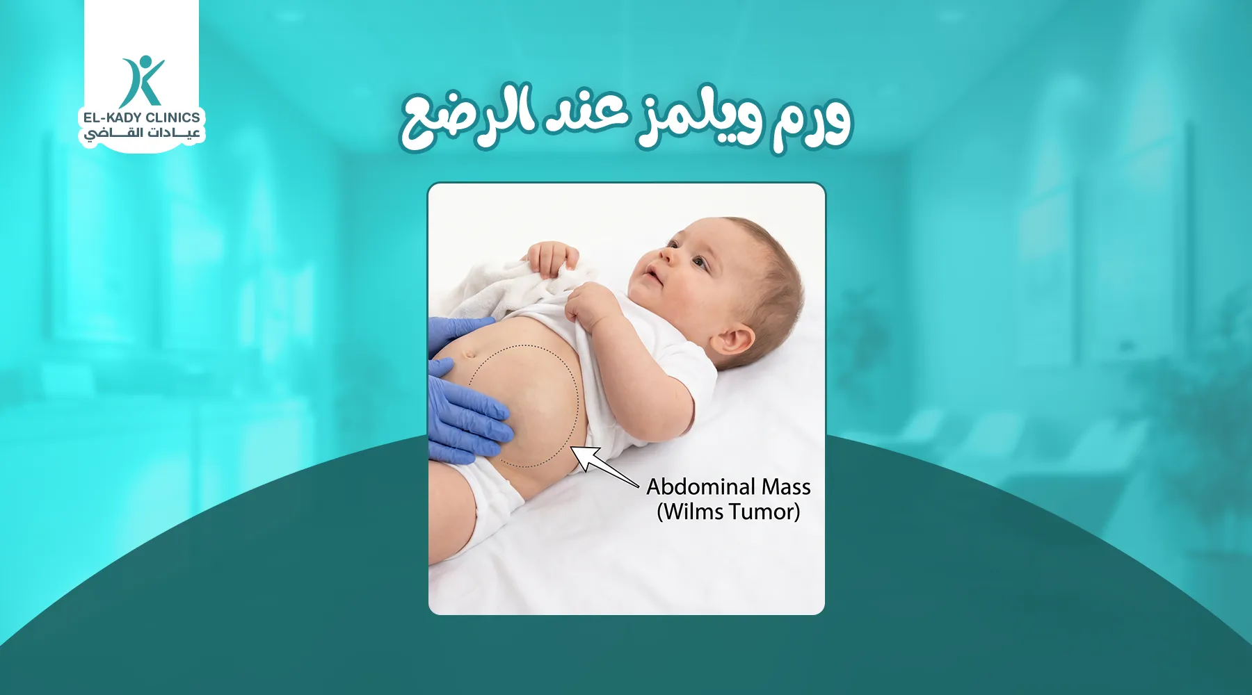 ورم ويلمز عند الرضع
