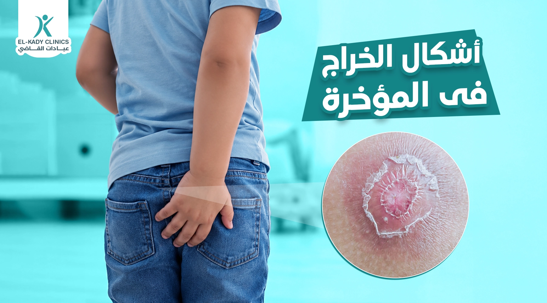أشكال الخراج في المؤخرة عند الأطفال