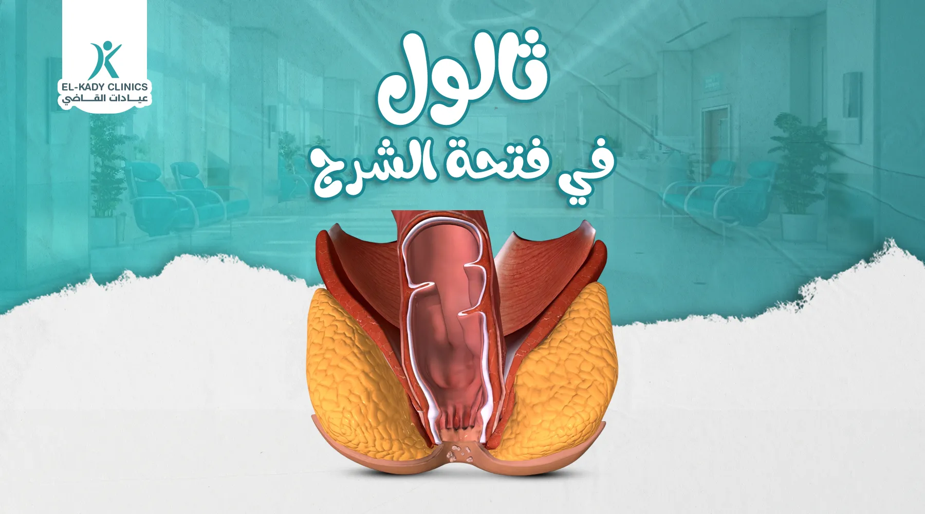 ثالول في فتحة الشرج وعلاقته بالورم اللقمي عند الأطفال