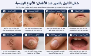 شكل الثالول بالصور عند الأطفال الأنواع الرئيسية
