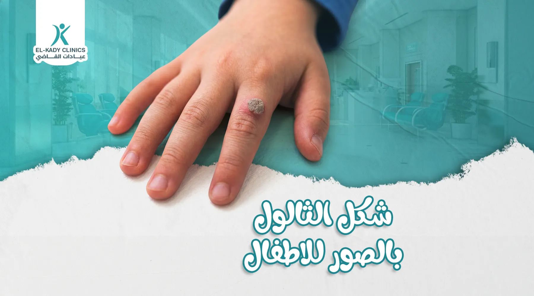 شكل الثالول بالصور عند الأطفال