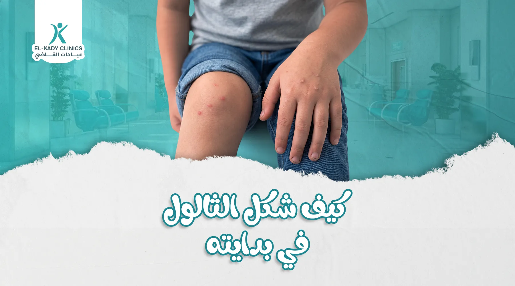 كيف شكل الثالول في بدايته لدى الأطفال؟