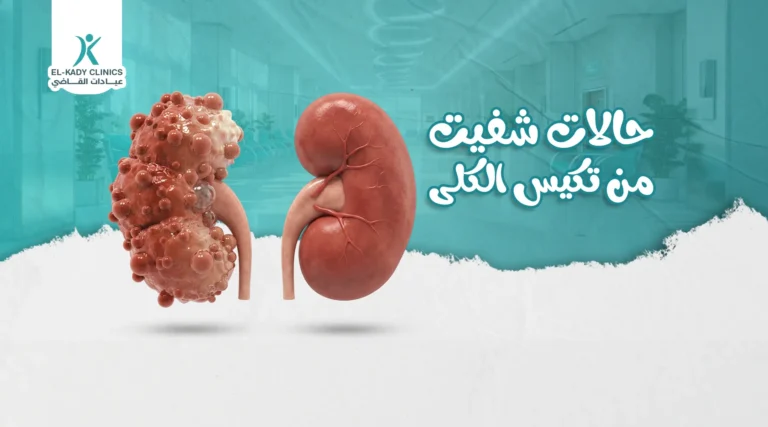 حالات شفيت من تكيس الكلى