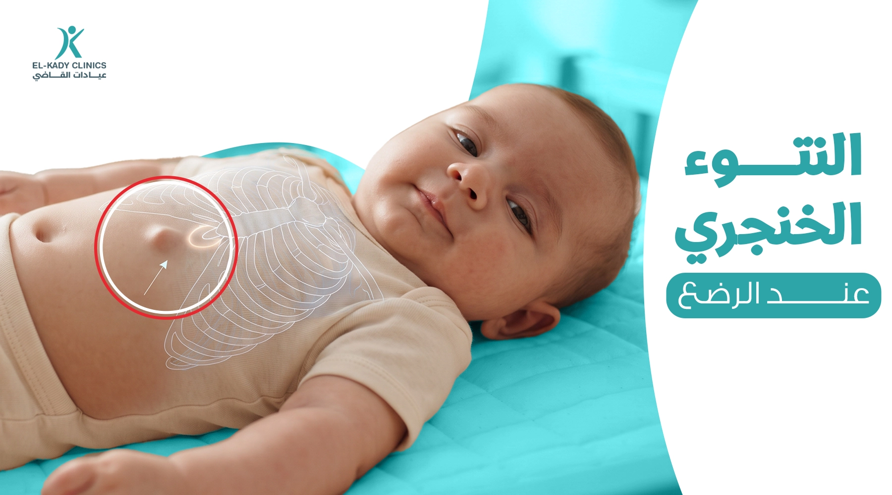النتوء الخنجري عند الرضع