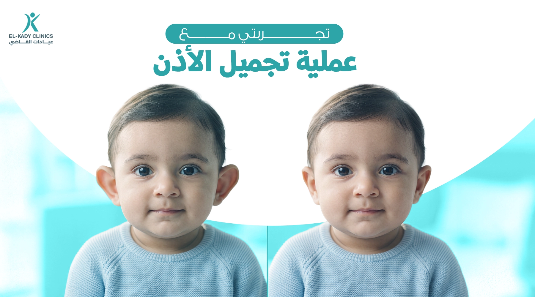 تجربتي مع عملية تجميل الأذن البارزة الخفاشية