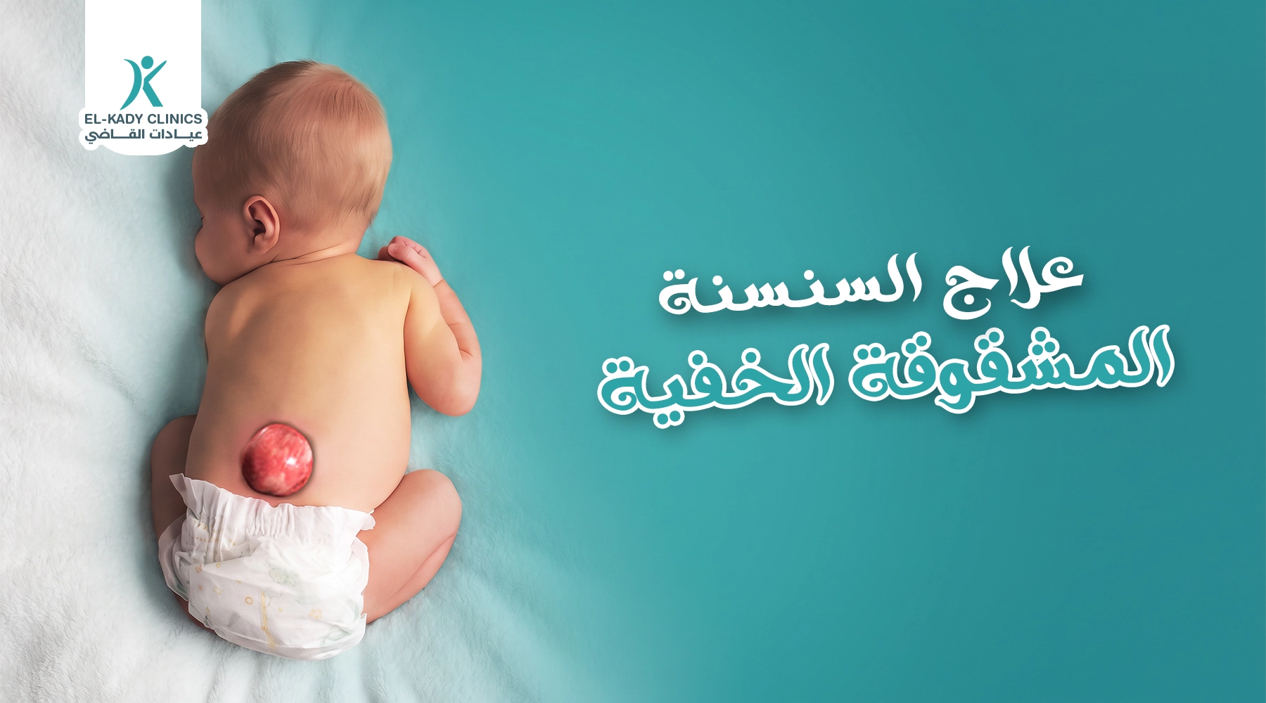 علاج السنسنة المشقوقة الخفية عند الأطفال